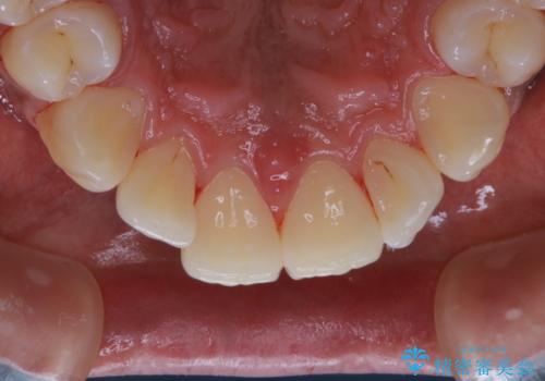 歯についたタバコのヤニをPMTCで綺麗にの治療後