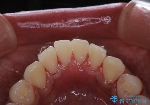 歯についたタバコのヤニをPMTCで綺麗にの治療後