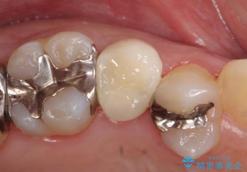 オールセラミッククラウン 銀歯を白くの治療後