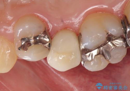 オールセラミッククラウン 銀歯を白くの治療後
