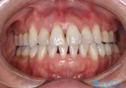 お茶による歯の黄ばみ取りの治療前