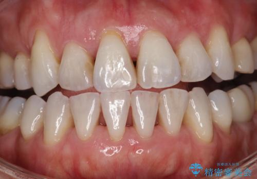 お茶による歯の黄ばみ取りの治療前