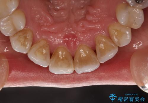 お茶による歯の黄ばみ取りの治療前