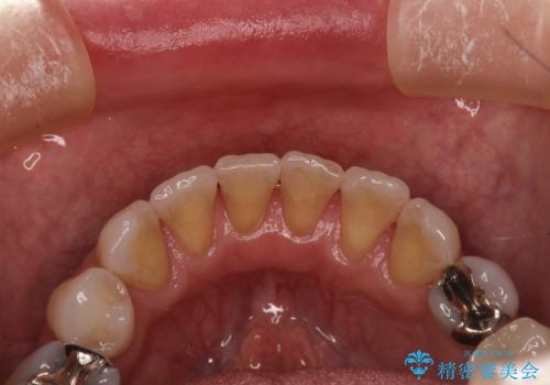 お茶による歯の黄ばみ取りの治療前