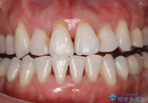 お茶による歯の黄ばみ取りの治療後