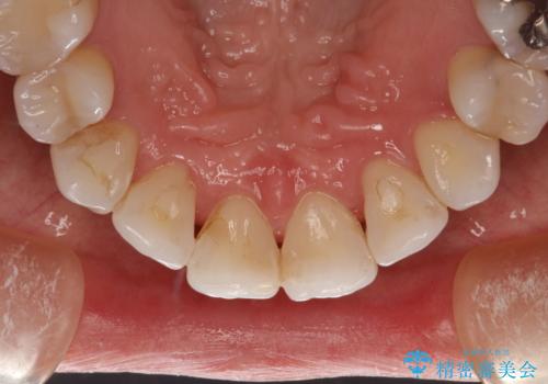 お茶による歯の黄ばみ取りの治療後
