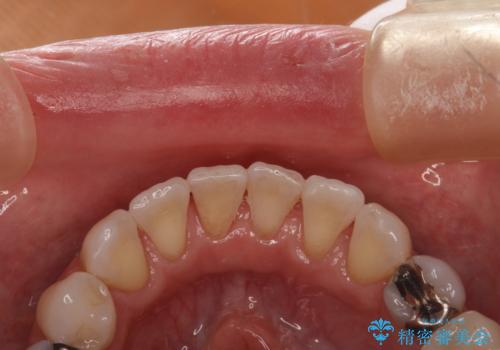 お茶による歯の黄ばみ取りの治療後