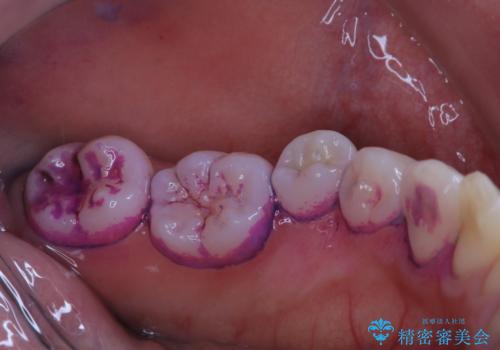 磨きにくい奥歯の歯磨き指導とPMTCの治療前