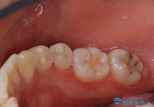 磨きにくい奥歯の歯磨き指導とPMTCの治療後