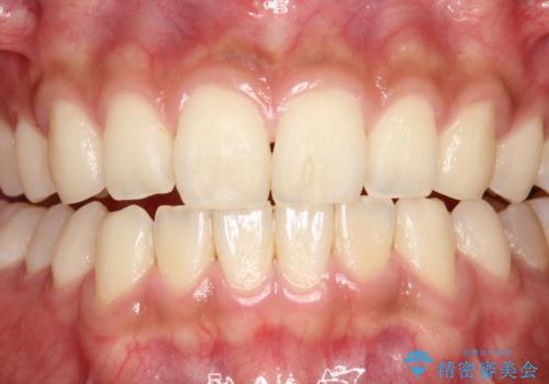 親知らずを抜く前にPMTCの症例 治療前