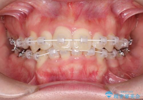 全体的ながたつき ワイヤーによる抜歯矯正で整った歯並びへの治療中