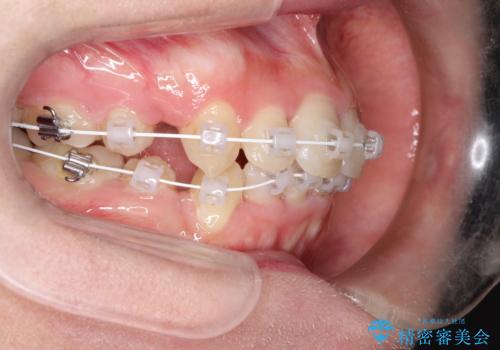 全体的ながたつき　ワイヤーによる抜歯矯正で整った歯並びへの治療中