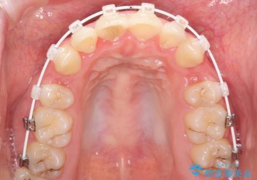 全体的ながたつき　ワイヤーによる抜歯矯正で整った歯並びへの治療中