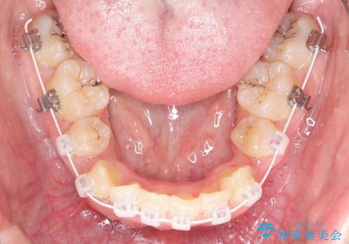 全体的ながたつき ワイヤーによる抜歯矯正で整った歯並びへの治療中