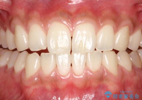 親知らずを抜く前にPMTCの症例 治療後