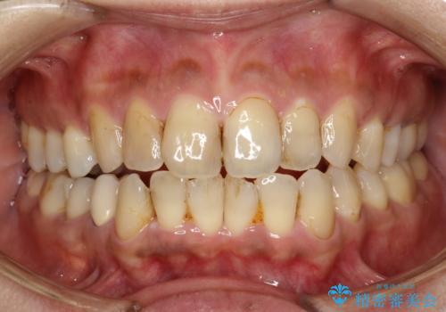 歯と歯の間の着色除去