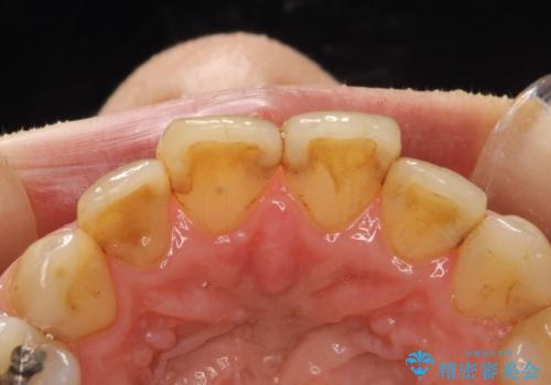 歯と歯の間の着色除去の治療前