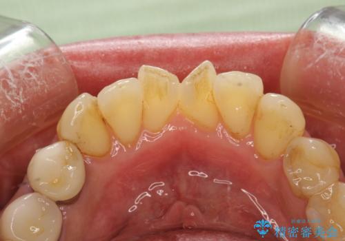 歯と歯の間の着色除去の治療前