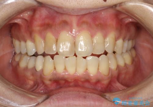 歯と歯の間の着色除去の治療後