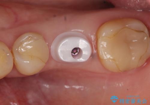 インプラント 割れてしまった歯の治療の治療中