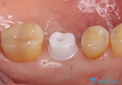 インプラント 割れてしまった歯の治療の治療中