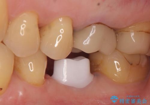 インプラント 割れてしまった歯の治療の治療中