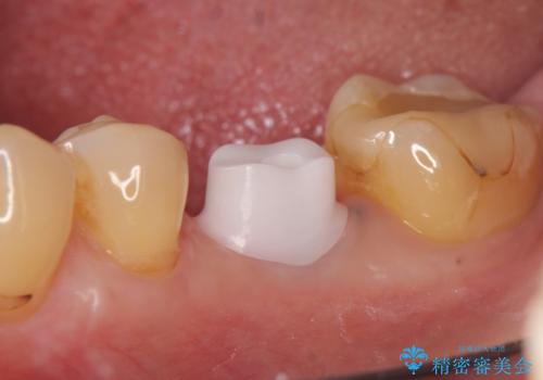インプラント 割れてしまった歯の治療の治療中