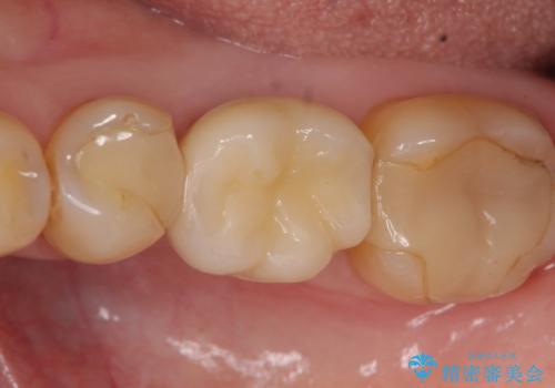 インプラント 割れてしまった歯の治療の治療後