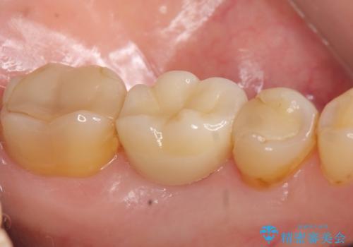 インプラント 割れてしまった歯の治療の治療後