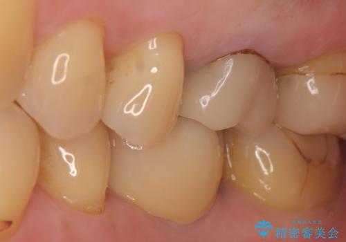 インプラント 割れてしまった歯の治療の治療後