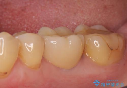 インプラント 割れてしまった歯の治療の症例 治療後