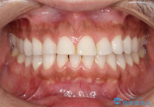 PMTCでお口のメンテナンスの症例 治療前
