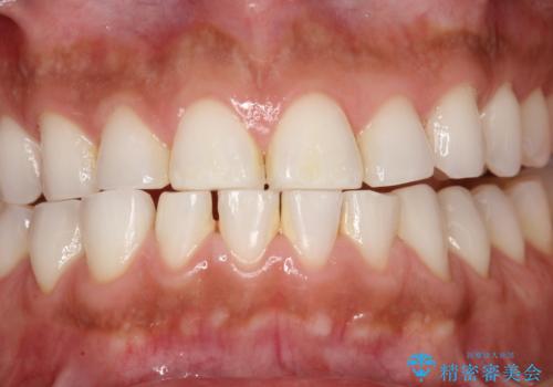 PMTCでお口のメンテナンスの治療前