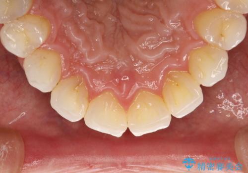 PMTCでお口のメンテナンスの治療前