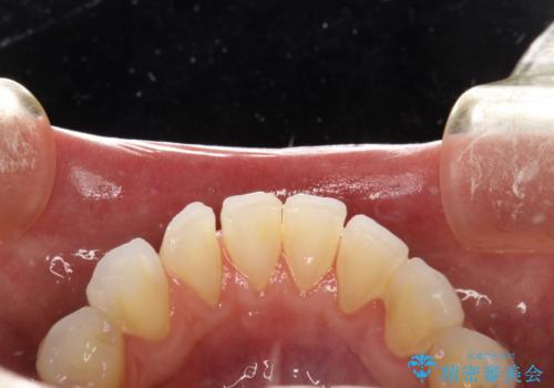 PMTCでお口のメンテナンスの治療前