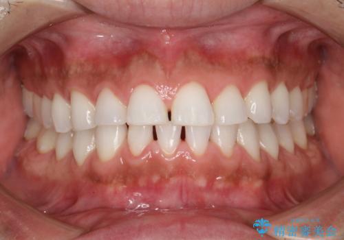 PMTCでお口のメンテナンスの症例 治療後