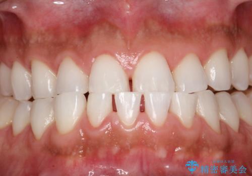 PMTCでお口のメンテナンスの治療後