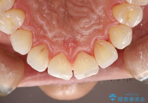 PMTCでお口のメンテナンスの治療後