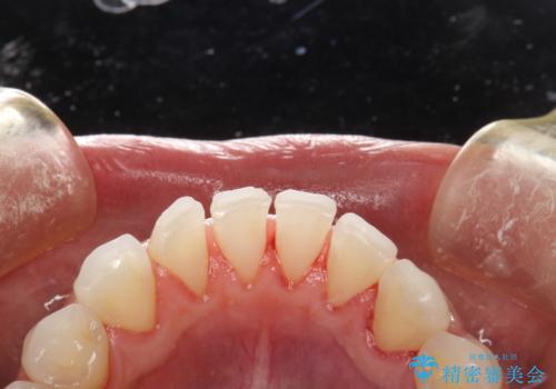 PMTCでお口のメンテナンスの治療後