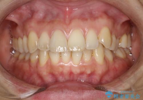 お口のさっぱり感とツルツル感をPMTCでの治療前