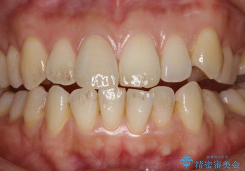 お口のさっぱり感とツルツル感をPMTCでの治療前