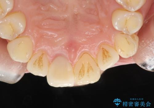 お口のさっぱり感とツルツル感をPMTCでの治療前