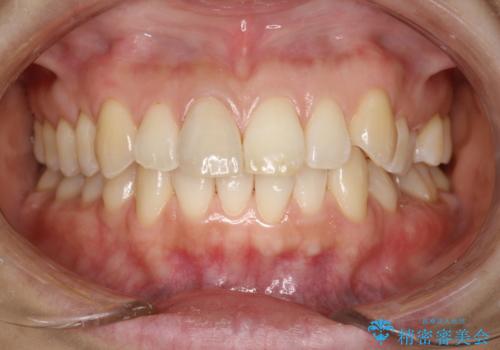 お口のさっぱり感とツルツル感をPMTCでの治療後