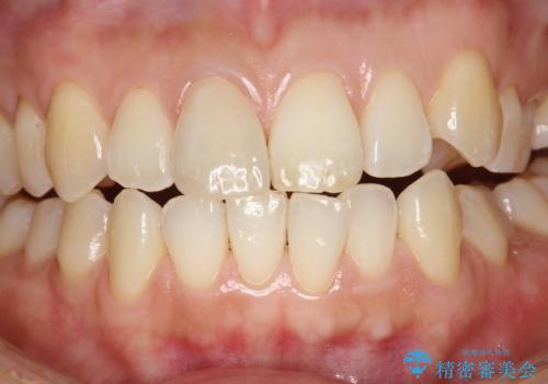 お口のさっぱり感とツルツル感をPMTCでの治療後