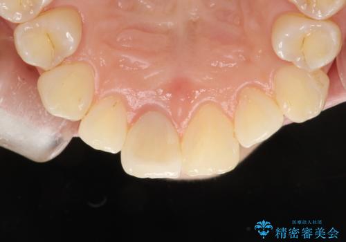 お口のさっぱり感とツルツル感をPMTCでの治療後