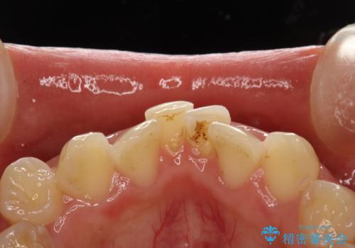 矯正治療開始前のPMTCの症例 治療前