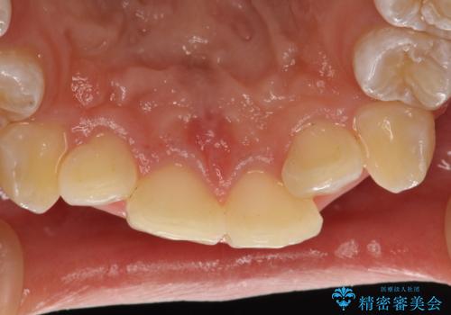 矯正治療開始前のPMTCの治療後