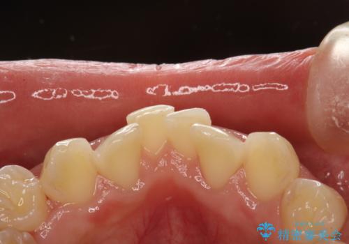 矯正治療開始前のPMTCの症例 治療後