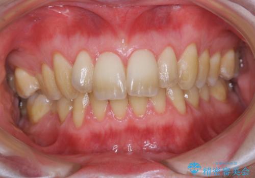 久しぶりの歯科医院にて歯のクリーニングの治療前