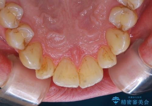 久しぶりの歯科医院にて歯のクリーニングの治療前